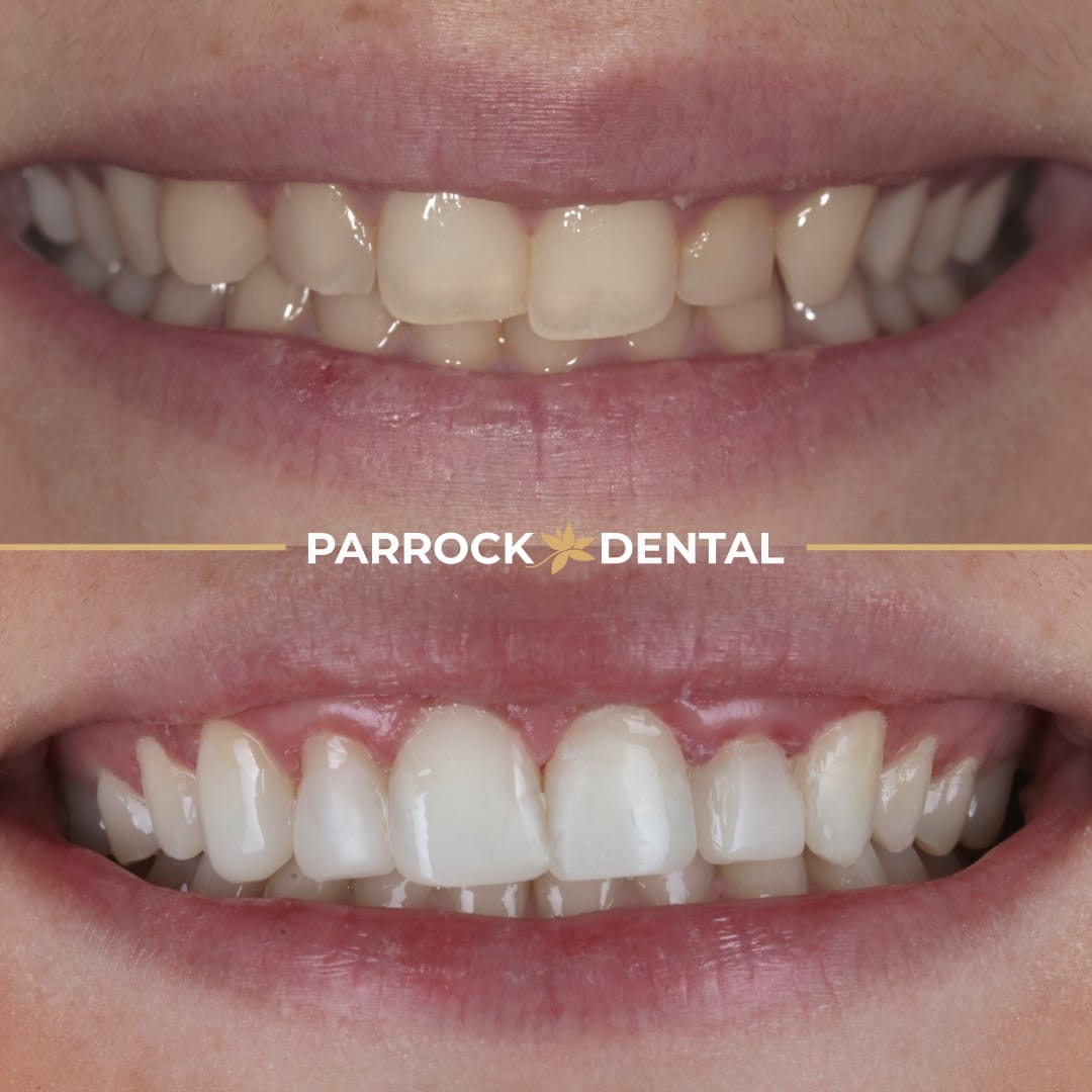 composite-bonding-before-after-1