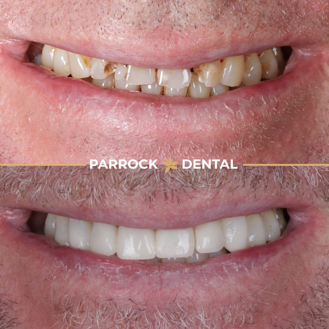 composite-bonding-before-after-2