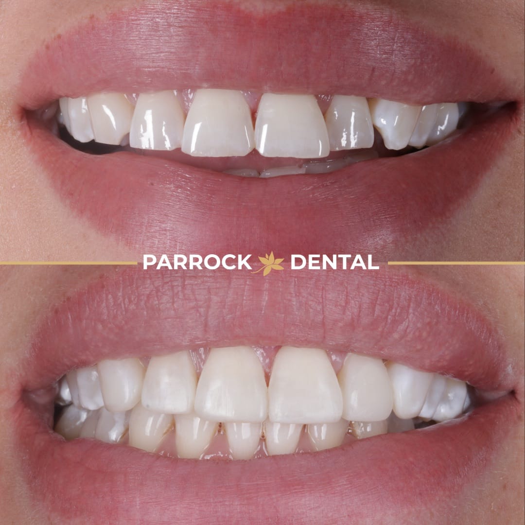 composite-bonding-before-after-3