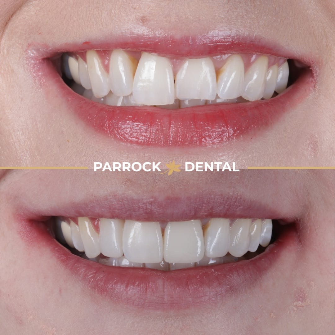composite-bonding-before-after-4