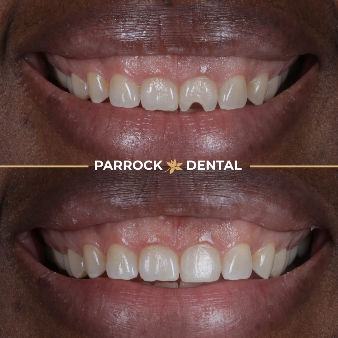 composite-bonding-before-after-5