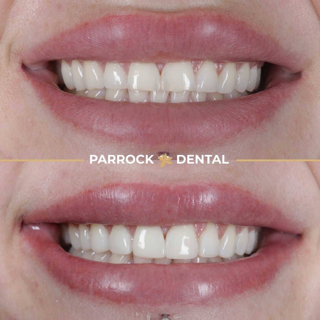 composite-bonding-before-after-6