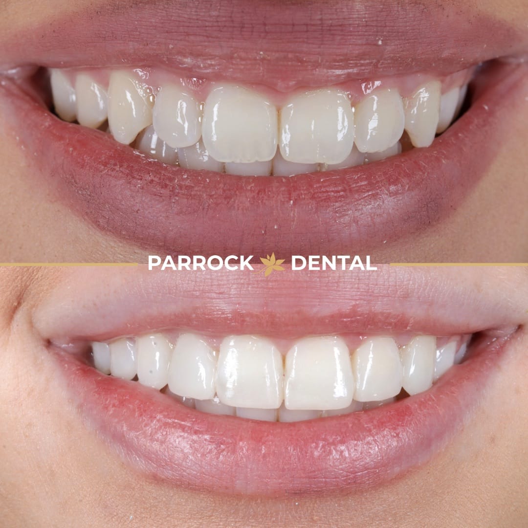 composite-bonding-before-after-7
