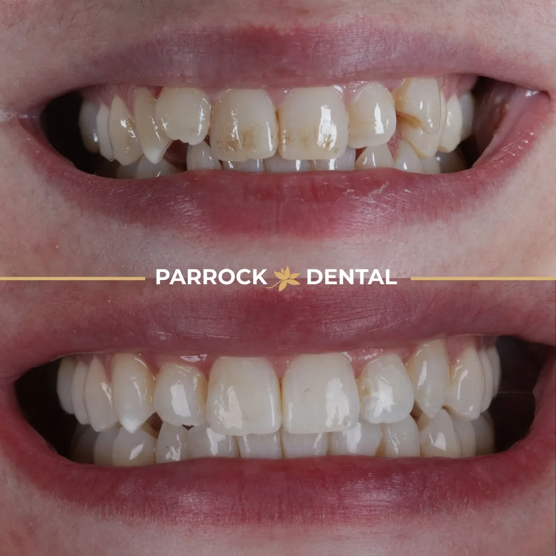 invisalign-dartford-dental-before-after-5.jpeg