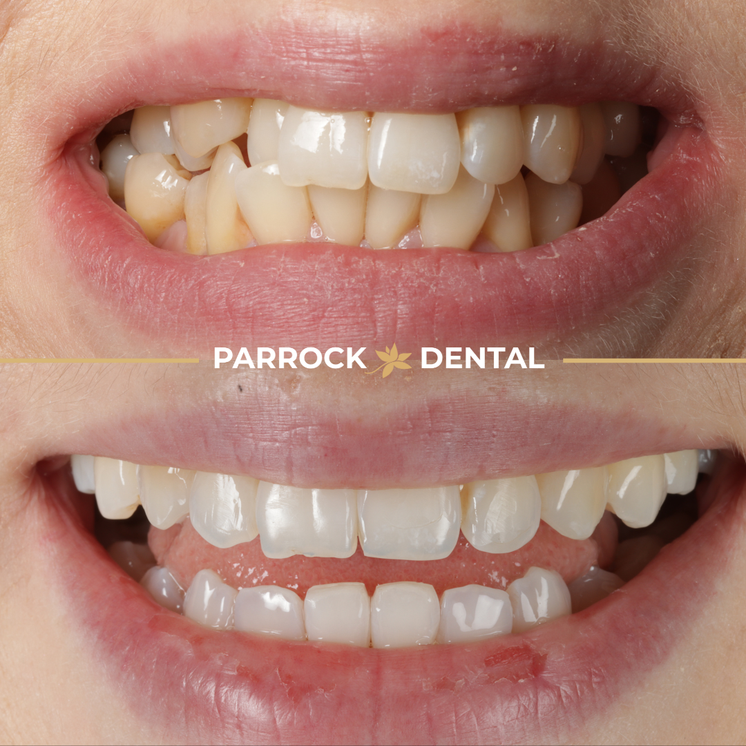 Karolina-Kuteowske-Invisalign
