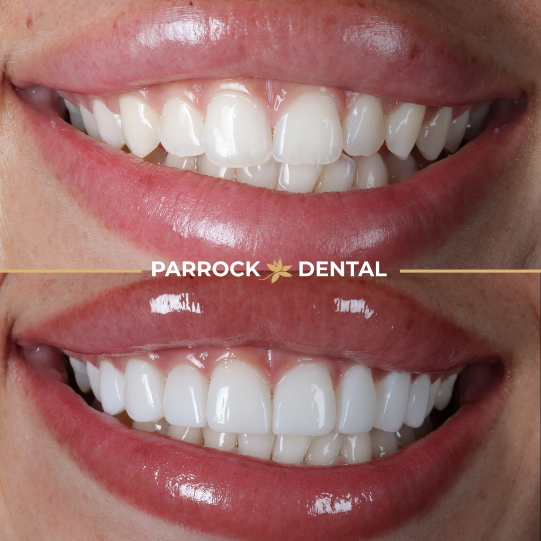 Renee French - Composite Bonding Before - 3